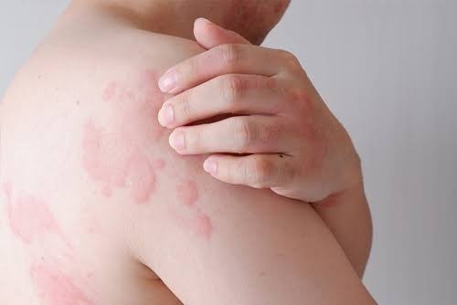 skin allegies